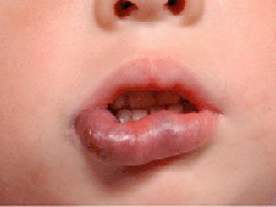 Puffy होंठ: malaise के चार कारणों